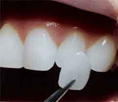 Реставрация зуба