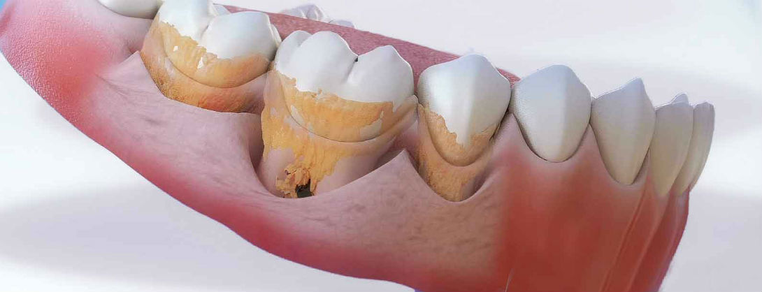 оголение зубных корней