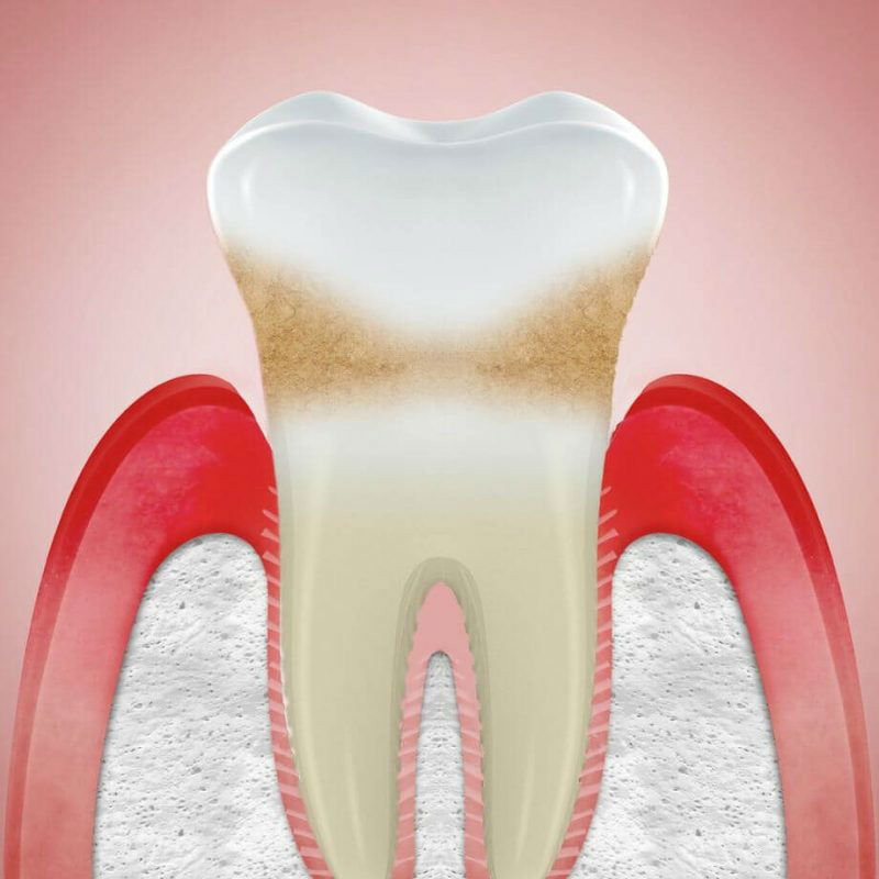 Подвижность зуба
