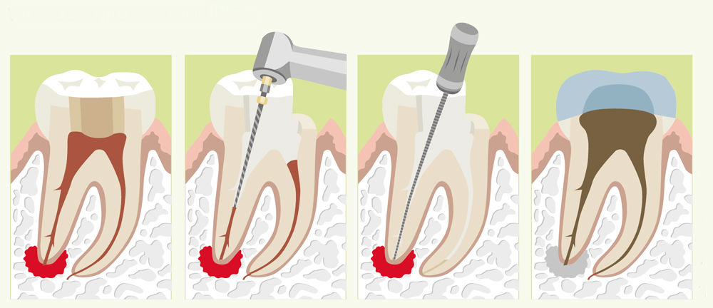Лечение гранулемы зуба
