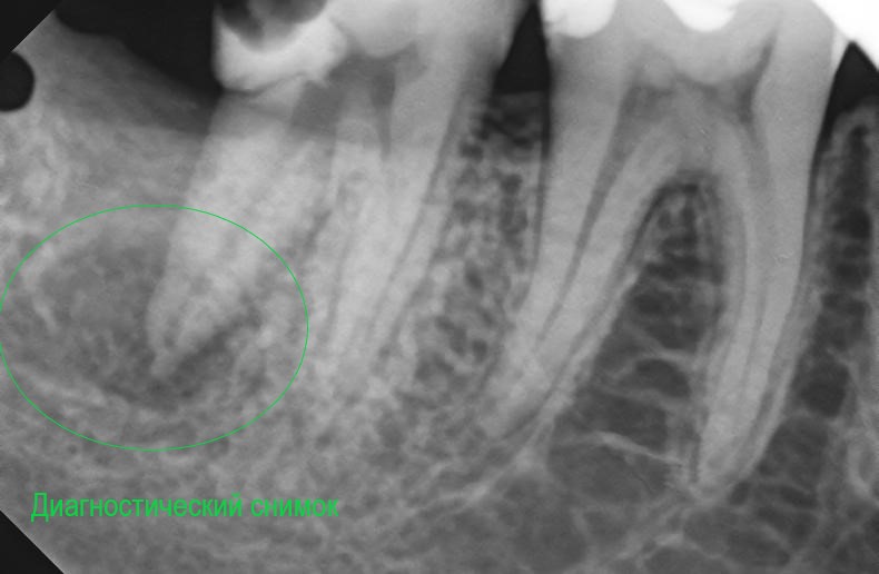 диагностический снимок 47 зуб