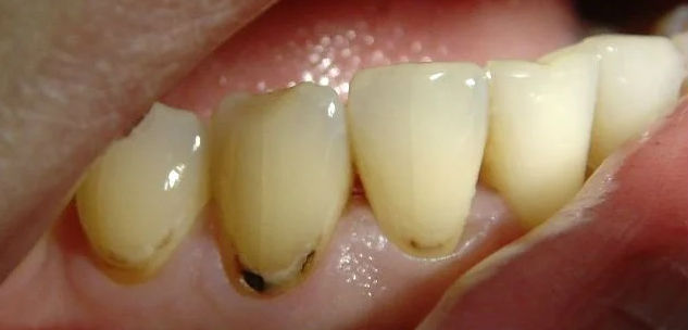 Дырки на зубах у ребенка: причины, лечение, профилактика