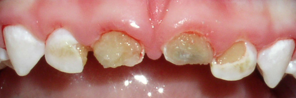 Болят ли зубы у ребенка?