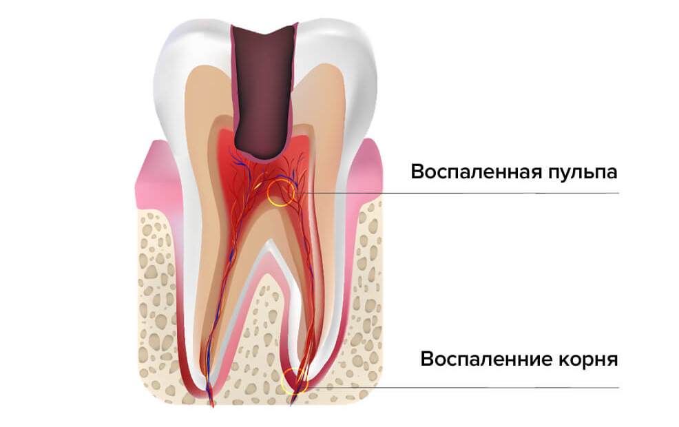 Лечение каналов зуба в клинике Семейный стоматолог