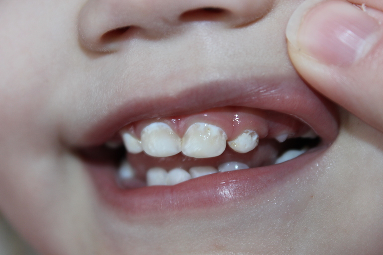 пятна на зубах у ребенка