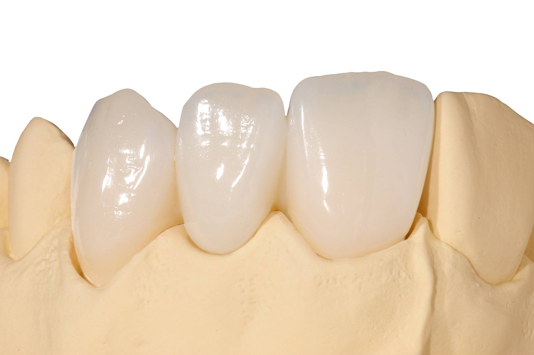 Выбор зубной коронки: что лучше цирконий или металлокерамика?