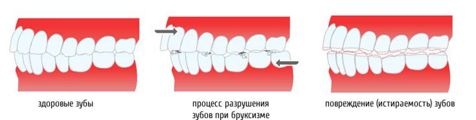 Процесс разрушения зубов при бруксизме