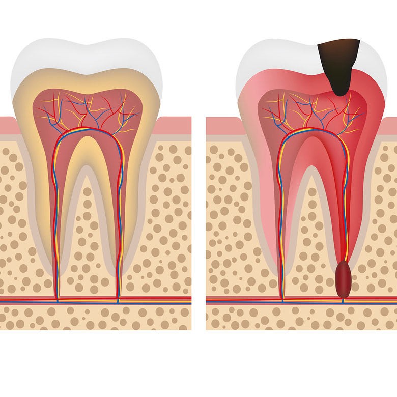 воспаление в области корня зуба