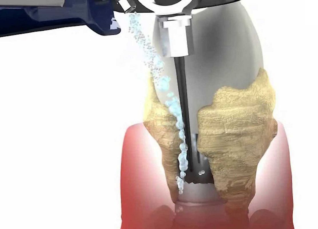 консервативное лечение периимплантита в Семейном стоматологе
