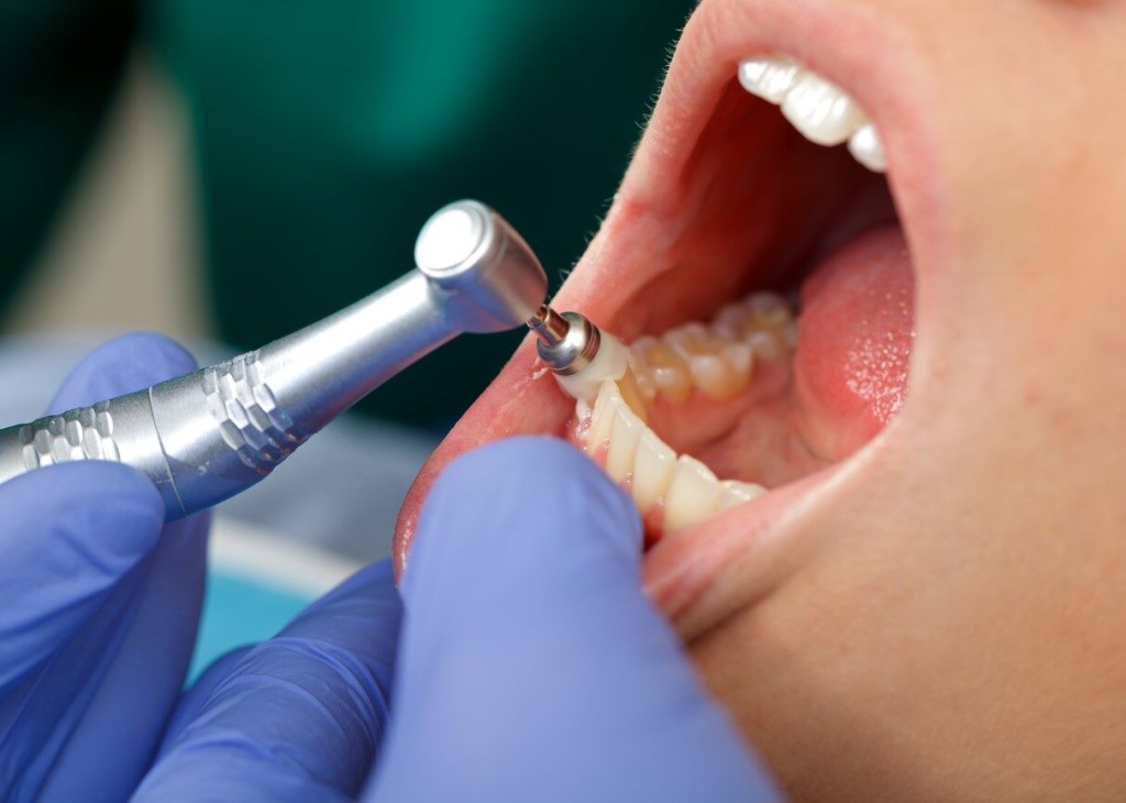 Профессиональная гигиена полости рта у детей в Семейном стоматологе