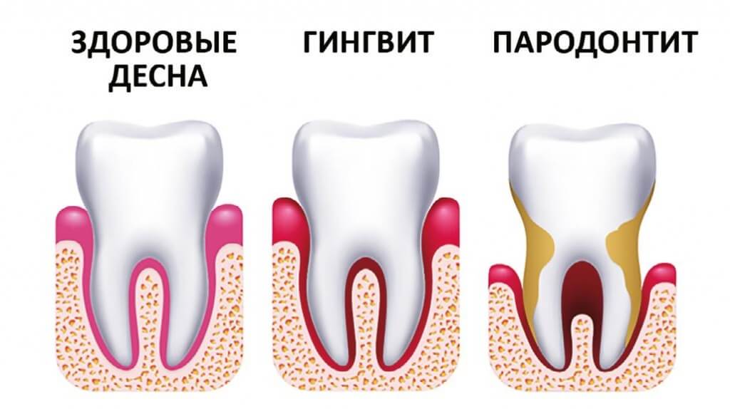 снятия зубных отложений в клинике Семейном стоматологе