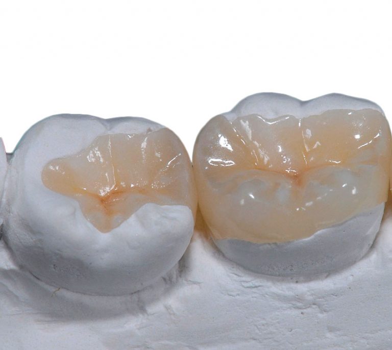 Восстановление зубов керамическими вкладками в Семейном стоматологе
