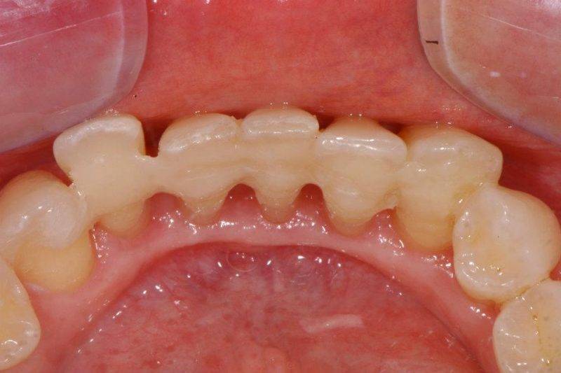 Шинирование зубов в клинике Семейном стоматологе
